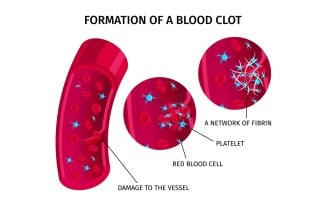 Blood Cells Thrombus 201250414 Vector Illustration Concept