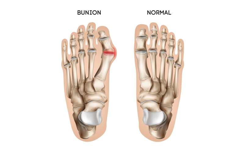 Realistic Bunion Foot 201230515 Vector Illustration Concept