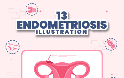 13 Endometriozis İllüstrasyonu