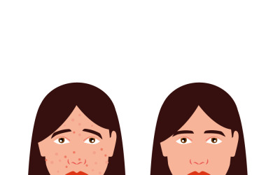 Visage avec et sans acné