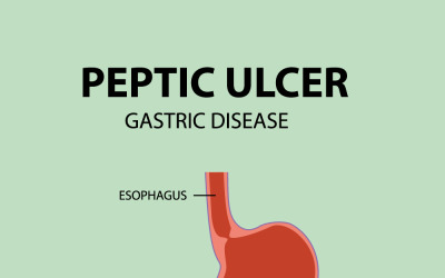Detailed Illustration of Human Stomach Ulcers and Gastric Anatomy