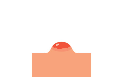 Realistic Pimple and Skin Inflammation Vector Illustration