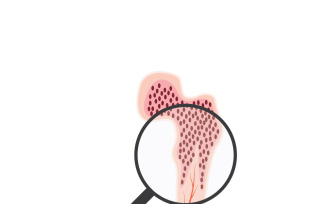 Bone Marrow Anatomy Medical Vector Icon Set