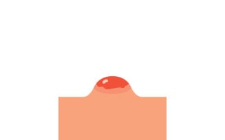 Realistic Pimple and Skin Inflammation Vector Illustration