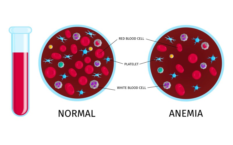 Blood Cells Anemia 201250412 Vector Illustration Concept