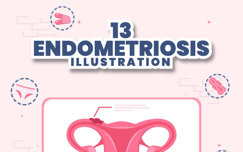 13 Illustrazione dell'endometriosi