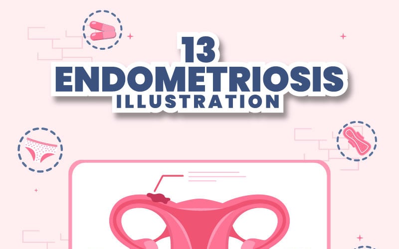 13 Ilustración de endometriosis