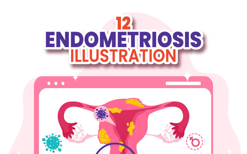 12 Ilustração de endometriose