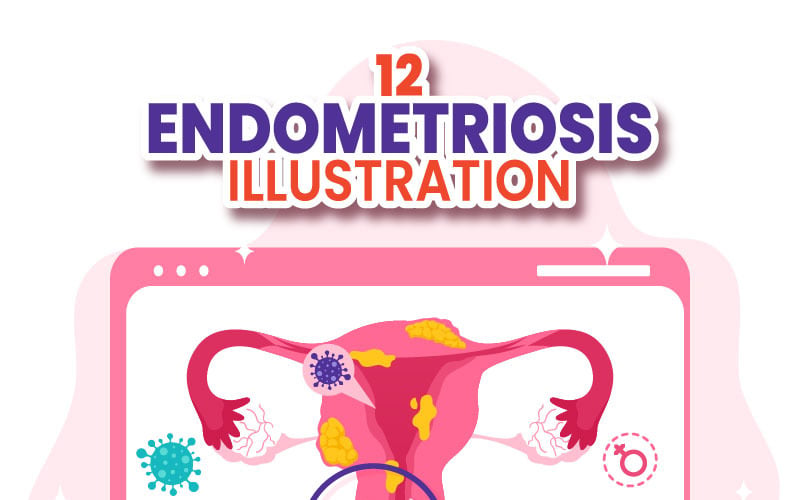 12 Ilustracja dotycząca endometriozy