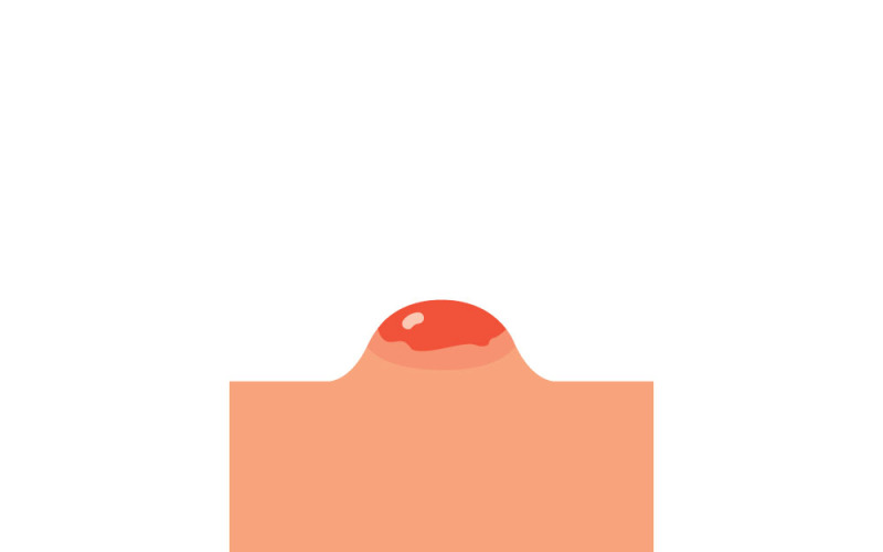 Realistische puistjes- en huidontstekingsvectorillustratie