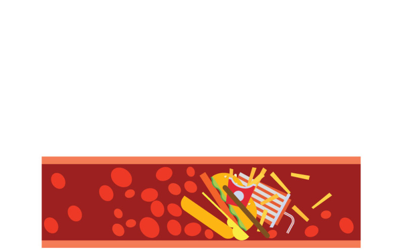 Artère bouchée par le cholestérol lié à la restauration rapide : illustration des dangers pour la santé